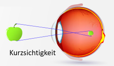 Kurzsichtigkeit Und Weitsichtigkeit Optik Einfach Erklart