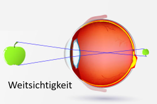 Weitsichtigkeit